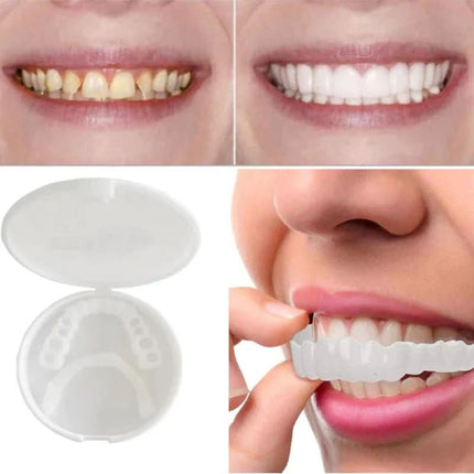 Innowacyjne Licówki Dentystyczne SnapFit – Idealny Uśmiech Bez Wizyt u Dentysty 3