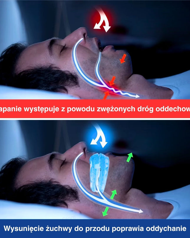 Regulowany Ustnik Przeciw Chrapaniu z Mechanizmem Śrubowym – Wygodne Dostosowanie dla Lepszej Jakości Snu 3